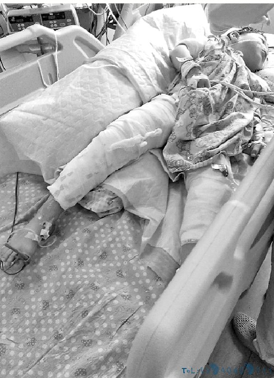 4岁男孩一屁股坐进开水桶这个清贫的家庭，已痛得无法呼吸