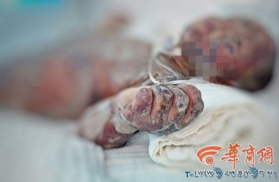 帮帮他们！洗澡用甲醇取暖突然爆炸阎良区小哥俩被烧伤